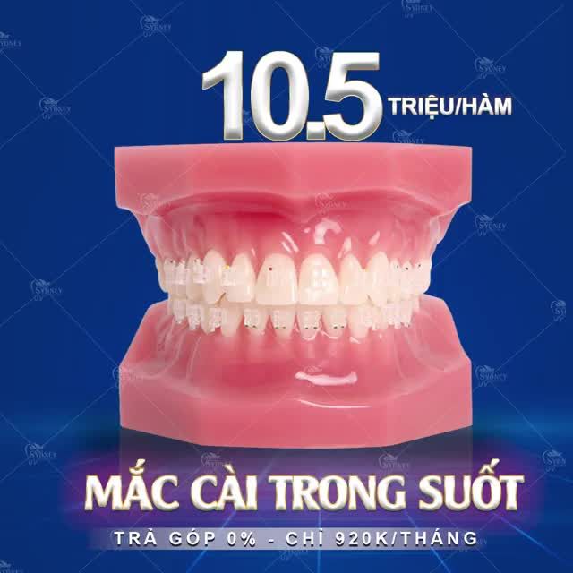 NIỀNG RĂNG TRONG SUỐT – KHÔNG LỘ