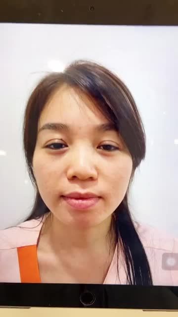 KH đã từng tiêm filler được 1 năm, sóng mũi thấp, đầu mũi cụp và ngắn, da mỏng, đầu mũi lệch sang phải.