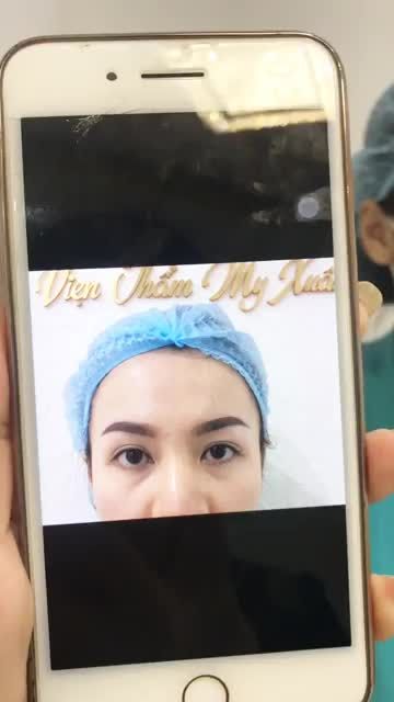 Khách hàng review ngay sau khi cắt mí