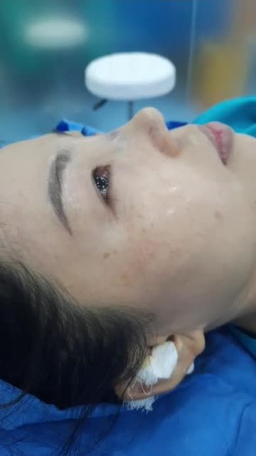 NÂNG MŨI DÁNG SLINE TỰ NHIÊN