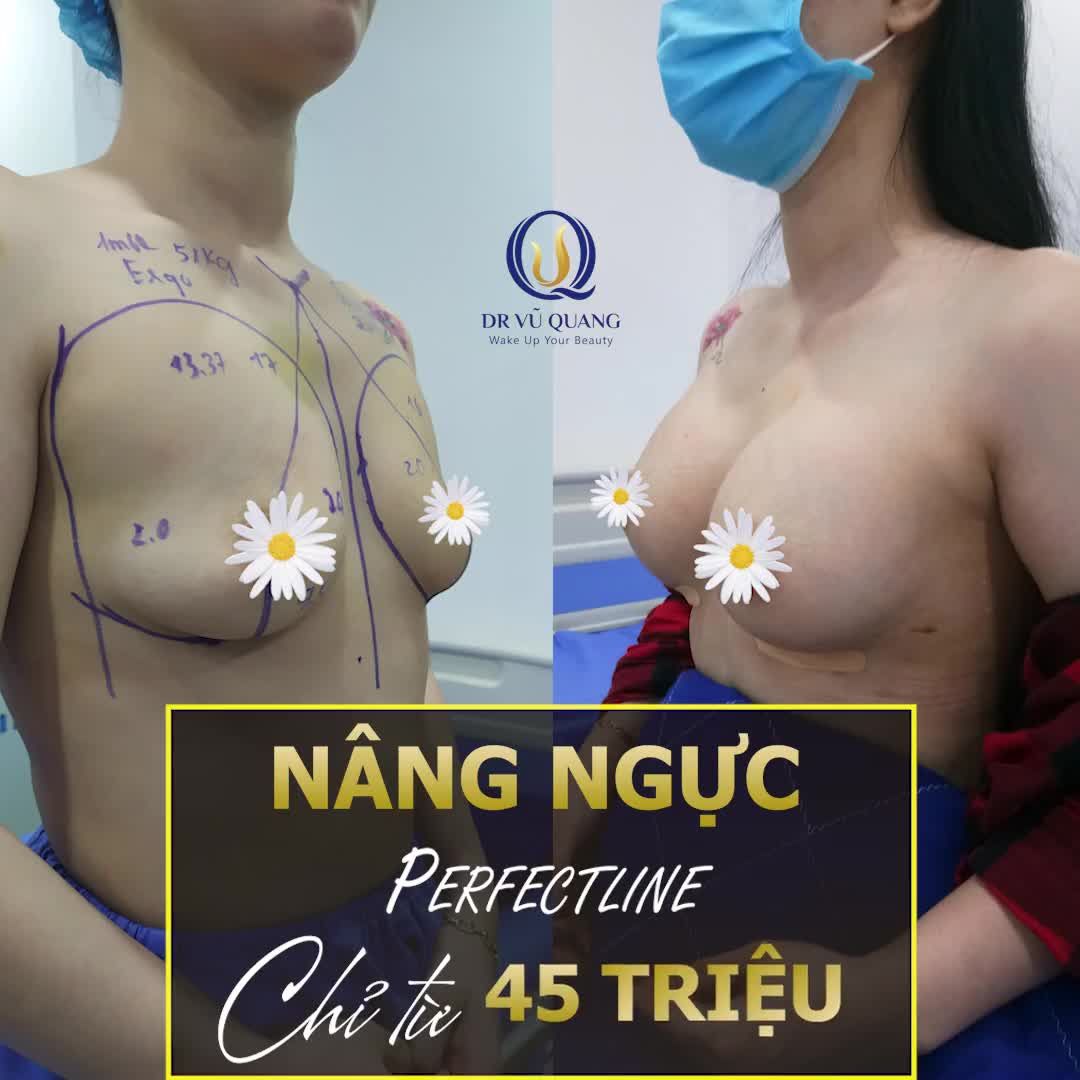 NÂNG VÒNG 1 PERFEC LINE