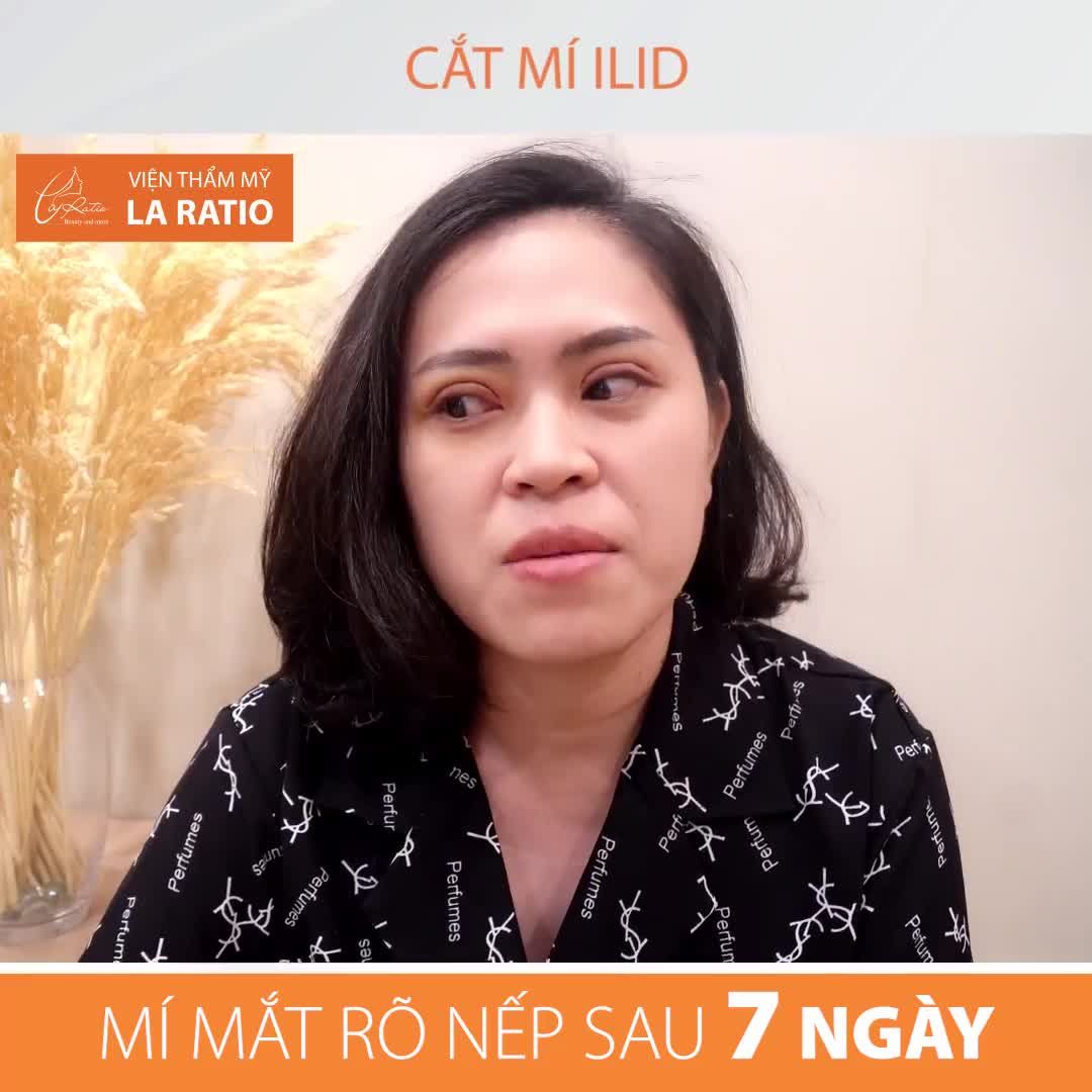 MÍ ĐẸP RÕ NẾP CHỈ SAU 7 NGÀY CẮT MÍ ILID