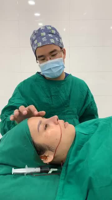 NÂNG MŨI KHÔNG ĐAU - LÊN DÁNG MŨI " SIÊU SỊN XÒ" SAU 45 P THỰC HIỆN.