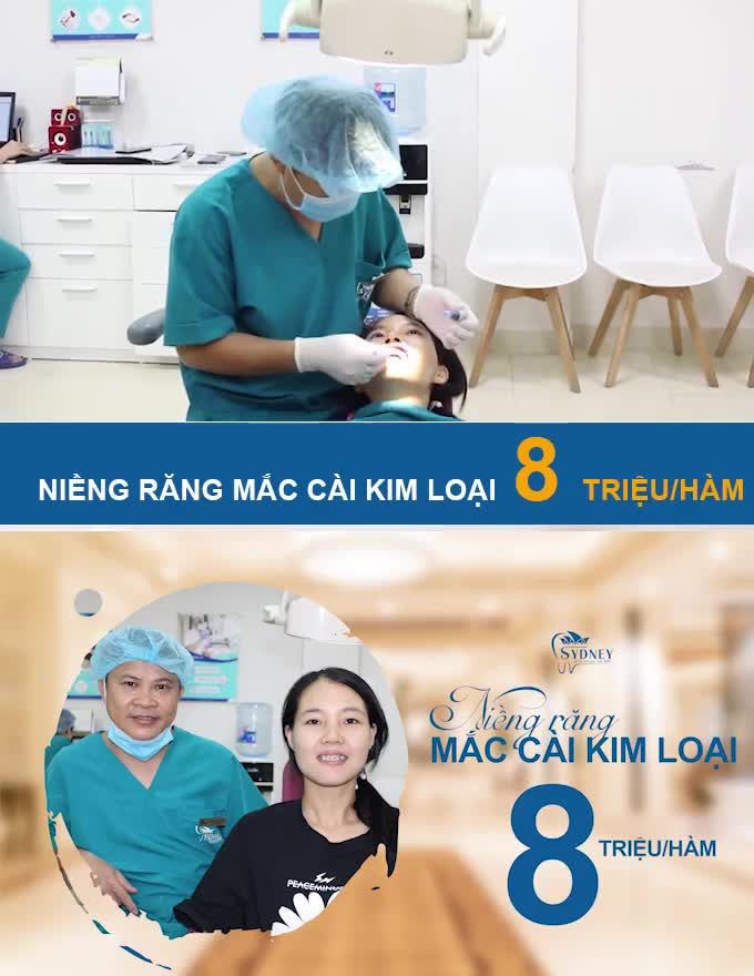 CHÚ Ý KHI NIỀNG RĂNG MẮC CÀI KIM LOẠI