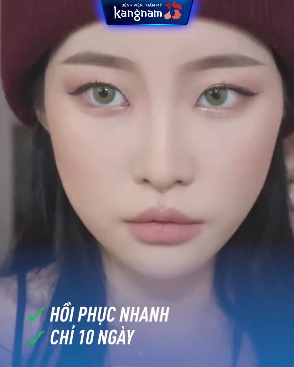 Độn cằm siêu nhanh - Nhẹ nhàng- Không cần nghỉ dưỡng