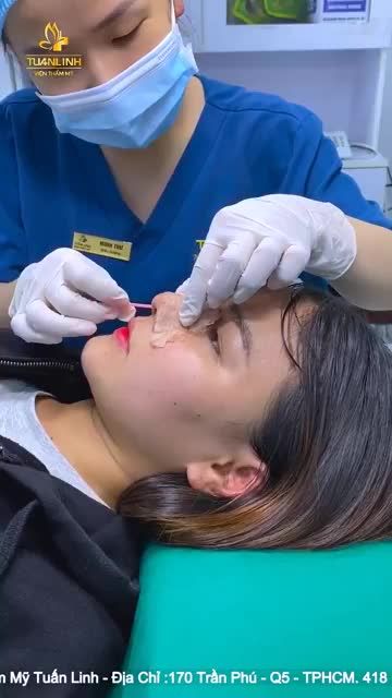 MŨI SAU 10 NGÀY THÁO NẸP SẼ NHƯ THẾ NÀO