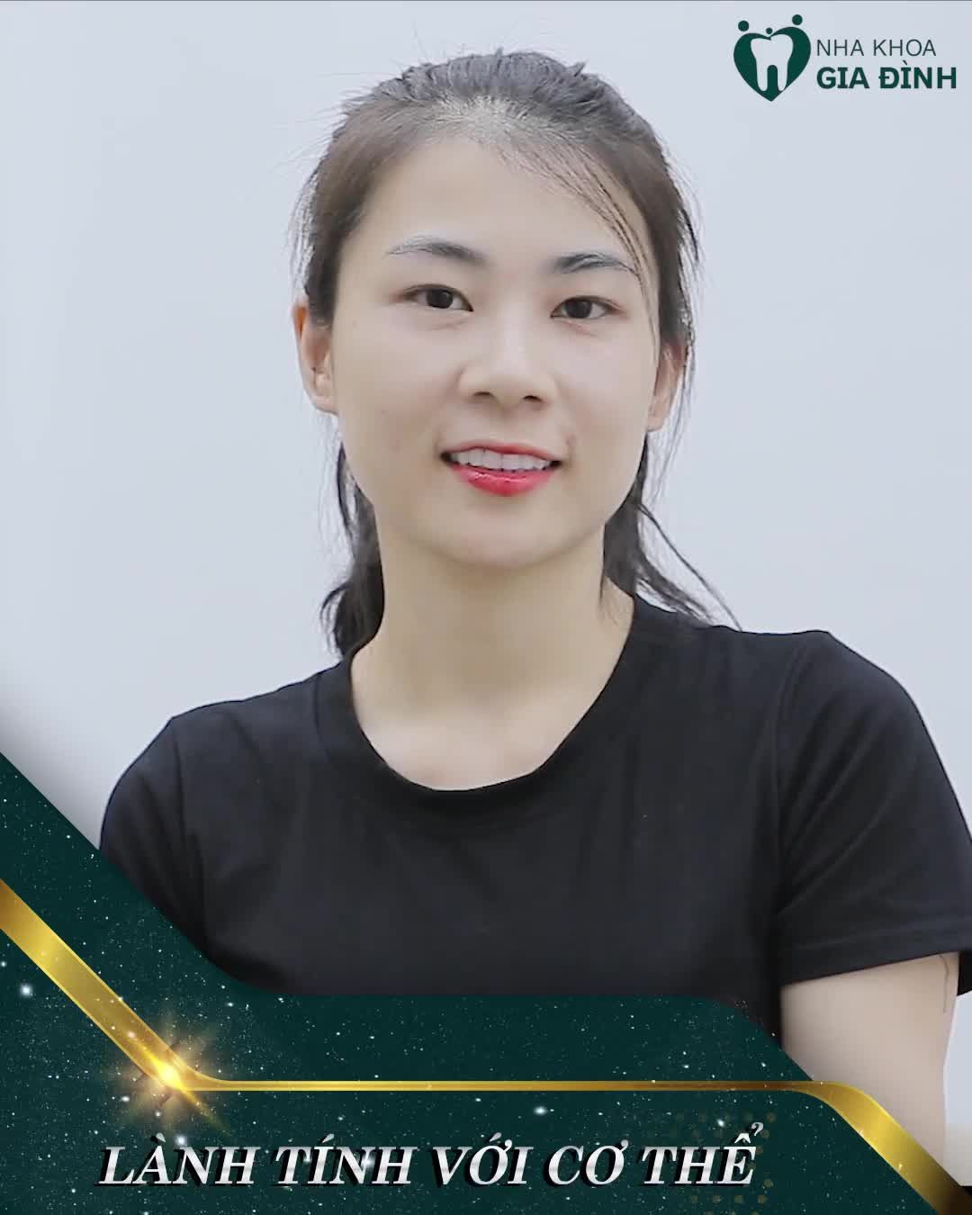 RĂNG SỨ E.MAX LỰA CHỌN HÀNG ĐẦU CHO PHỤC HÌNH RĂNG KHIẾM KHUYẾT
