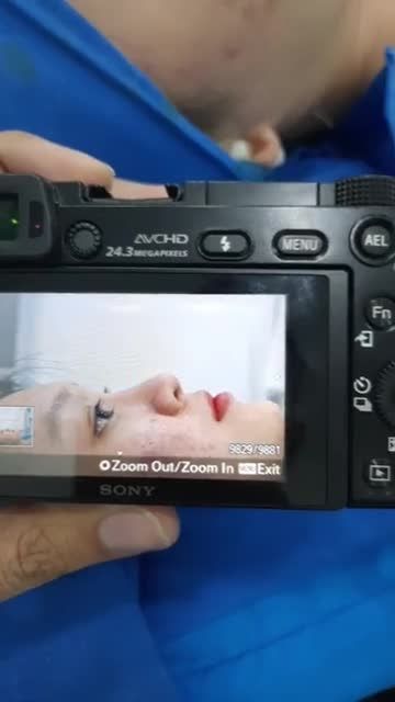 SIÊU PHẨM NÂNG MŨI BÁN CẤU TRÚC SỤN TAI ĐA LỚP sau 45 phút