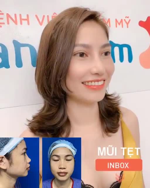 Chia tay MŨI TẸT - Sang chảnh tuyệt đối sau Nâng mũi
