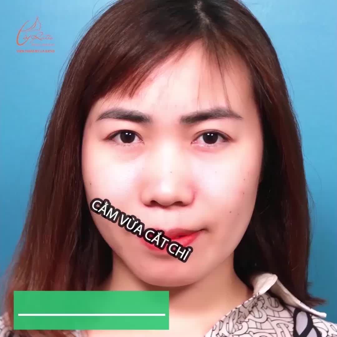 SỞ HỮU GÓC NGHIÊNG CHUẨN TỈ LỆ SAU KHI THỰC HIỆN COMBO NÂNG MŨI – ĐỘN CẰM