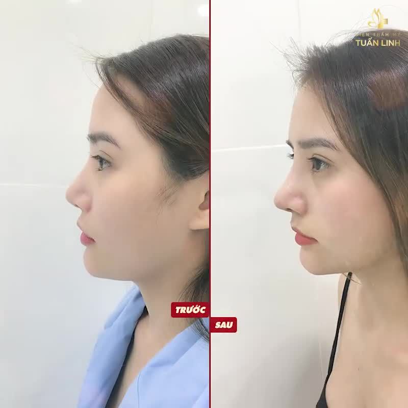 MŨI SAU NÂNG 10 NGÀY SẼ NHƯ THẾ NÀO?