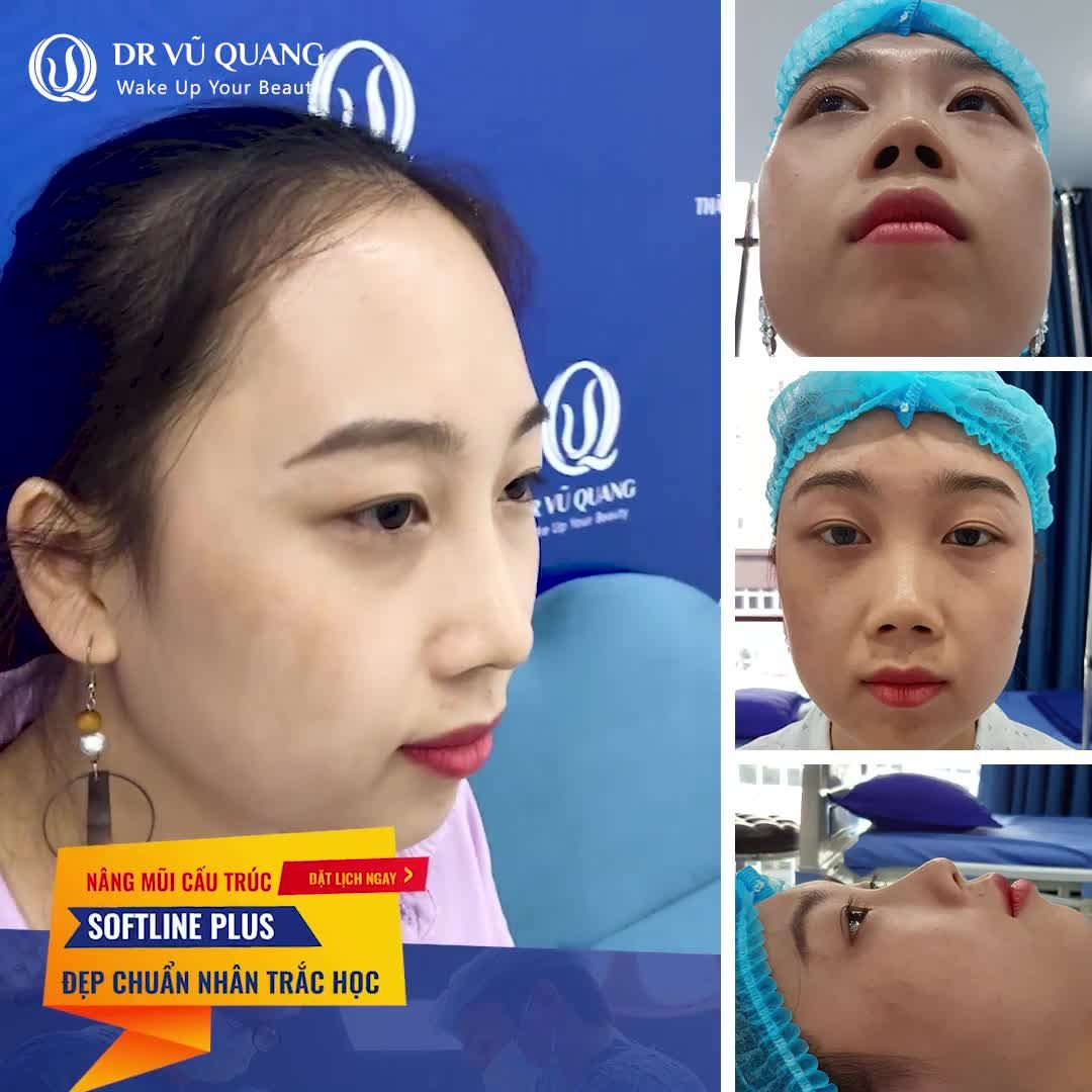 NÂNG MŨI CÔNG NGHỆ CAO Softline Plus - KHÔNG CẦN NẸP