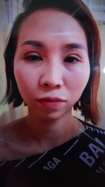 GHÉP MỠ MÁ ĐÀO TÀI LỘC