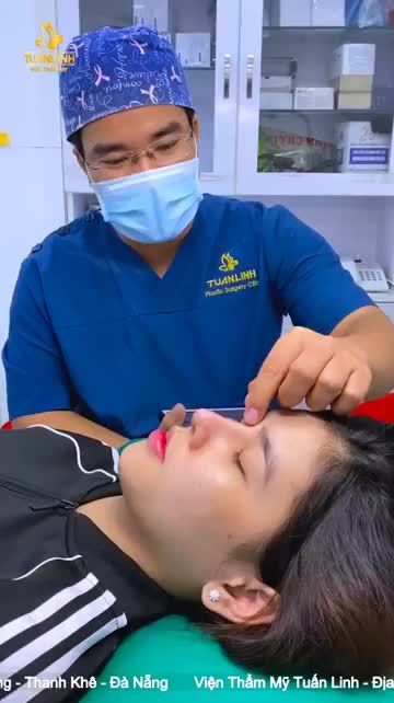 Khách hàng đến từ Sóc Trăng - Bạn thực hiện nâng mũi cấu trúc Surgiform và quay lại tái khám sau 1 tháng.