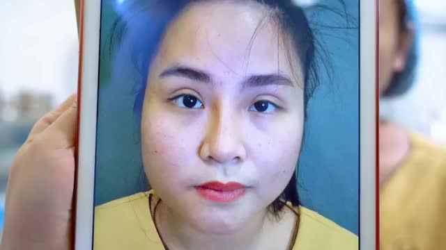 GIẢI CỨU MÍ HỎNG XUYÊN TRƯA CHO QUÝ KHÁCH HÀNG CÙNG CHIÊM NGƯỠNG SỰ THAY ĐỔI KHI ĐÔI MẮT ĐƯỢC CHỮA LÀNH BẰNG KỸ THUẬT DEEPTECH TẠI DR.HẢI LÊ.!