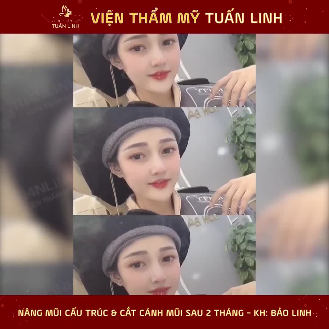 Khách hàng Bảo Linh Thực hiện dịch vụ nâng mũi cấu trúc kết hợp cắt cánh mũi tại Tuấn Linh sau 2 tháng.