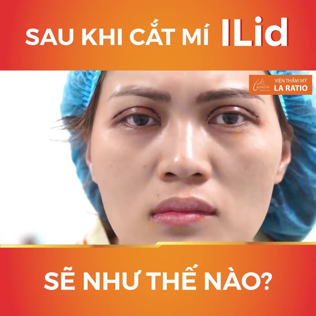 CẬN CẢNH KHÁCH HÀNG VỪA THỰC HIỆN XONG CA CẮT MÍ ILID