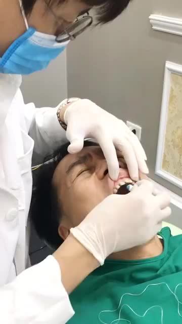 DÁN SỨ VENEER KHÔNG MÀI NHỎ RĂNG TẠI NHA KHOA GIA ĐÌNH