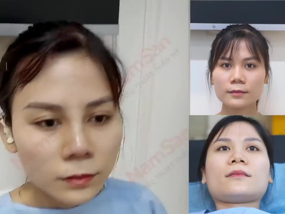 Nâng mũi cấu trúc dựng trụ chỉnh sửa trường hợp khá đặc biệt.