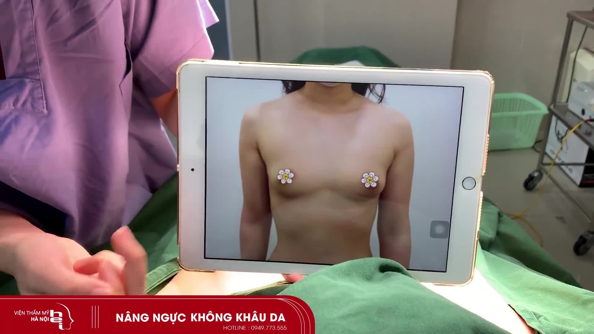 NÂNG NGỰC KHÔNG KHÂU DA  KẾT QUẢ SAU 45 PHÚT THỰC HIỆN NÂNG NGỰC
