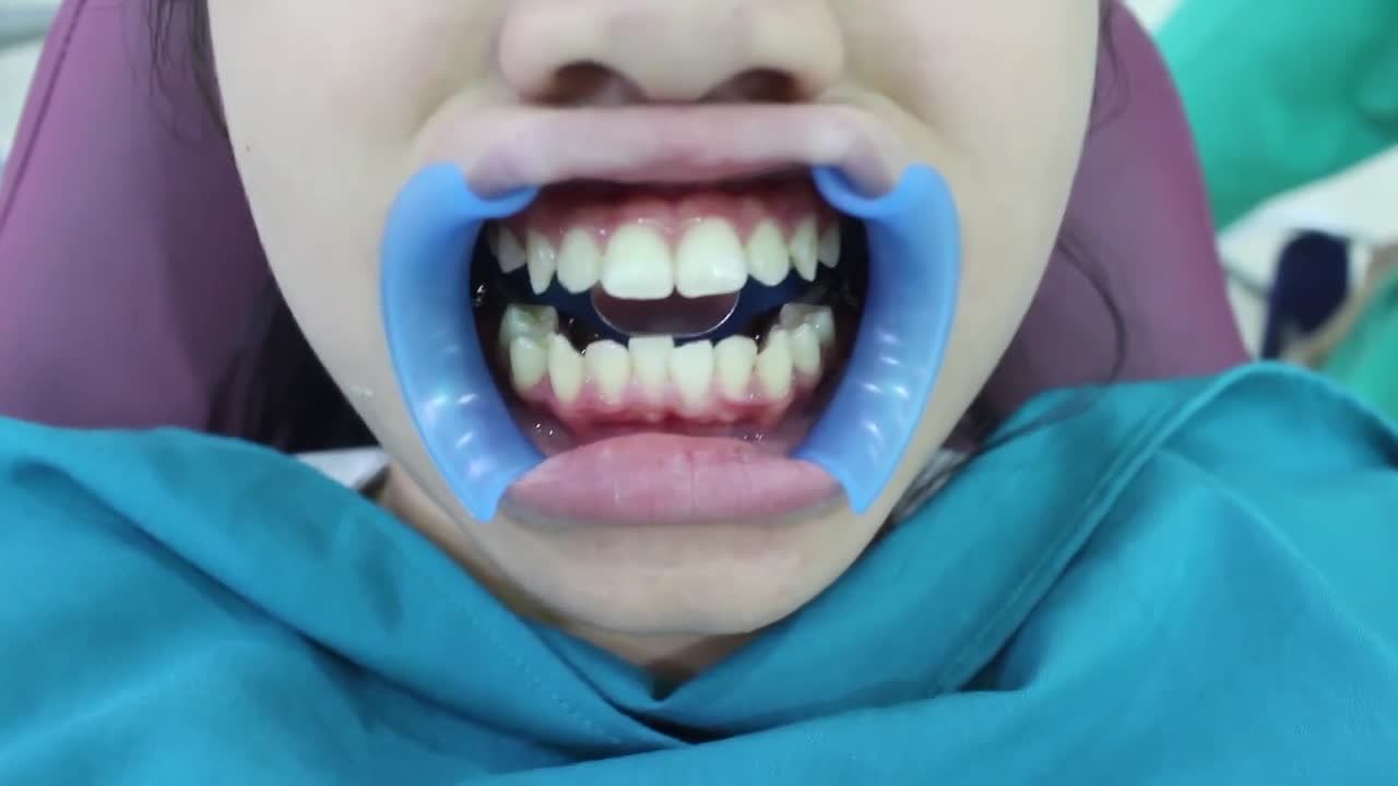 RĂNG NHƯ THẾ NÀO THÌ ĐẸP