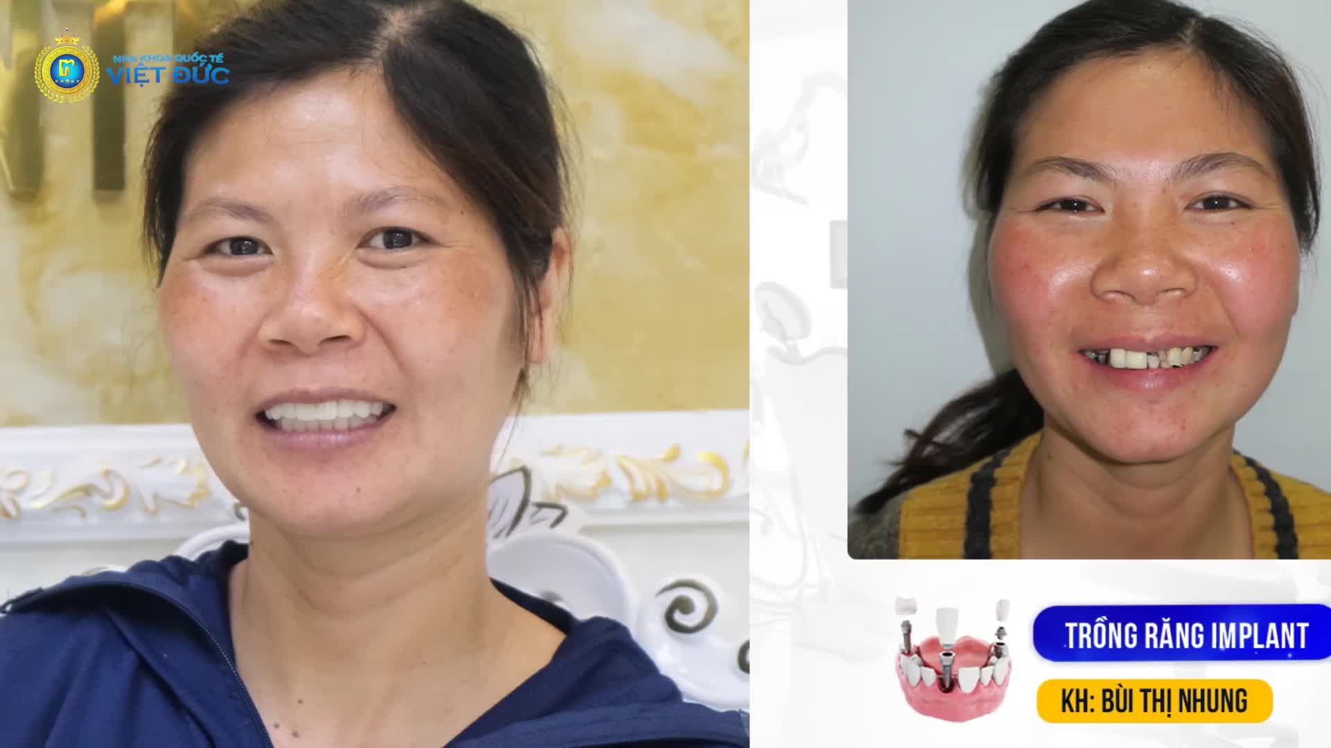 Trồng răng Implant trọn đúng địa chỉ - răng đẹp như ý - chi phí hợp lý