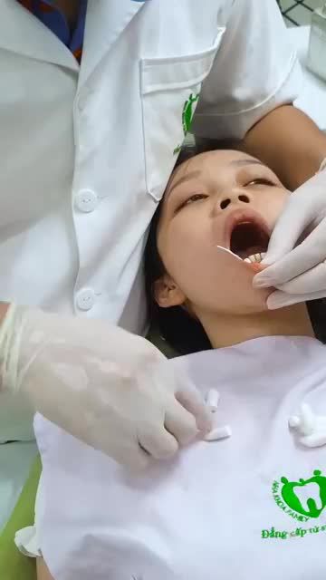 Dán sứ Veneer - Phục hình ít xâm lấn - Không mài nhỏ răng
