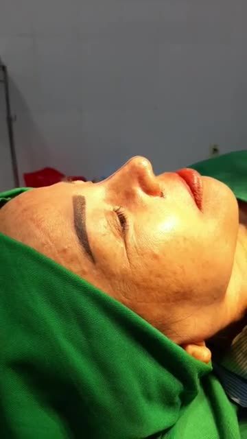 NÂNG MŨI BÁN CẤU TRÚC SỤN TAI ĐA LỚP CUỘN CÁNH MŨI PLASMA