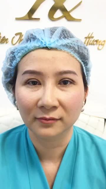 NẾP MÍ VỪA CẮT ĐỀU ĐẸP TỰ NHIÊN, NỮ KHÁCH HÀNG CHIA SẺ: "Cứ nghĩ cắt xong mắt sẽ sưng húp, đau lắm cơ. Ai ngờ nhẹ nhàng như không mà lại đẹp thế này!"