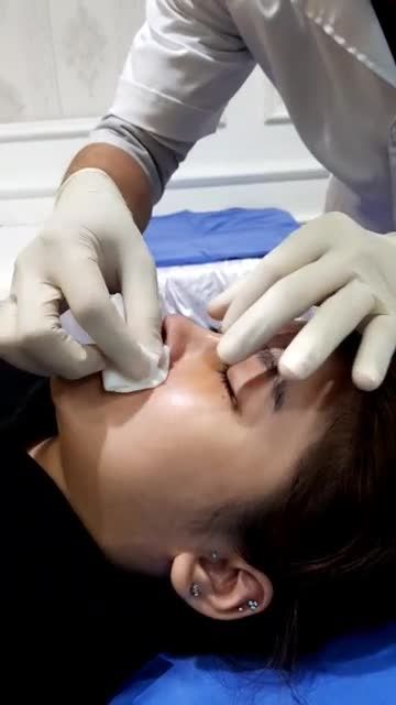 Quy trình thay nẹp mũi sau nâng 5 ngày tại Kanngam
