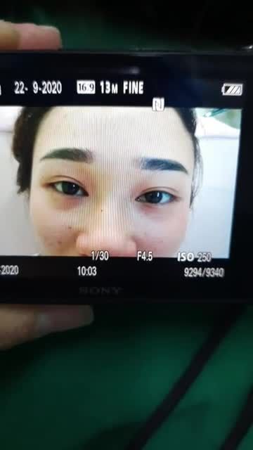 Cắt mắt Trung Hoa cho em gái đã từng nhấn mí ở Spa được 2 năm.