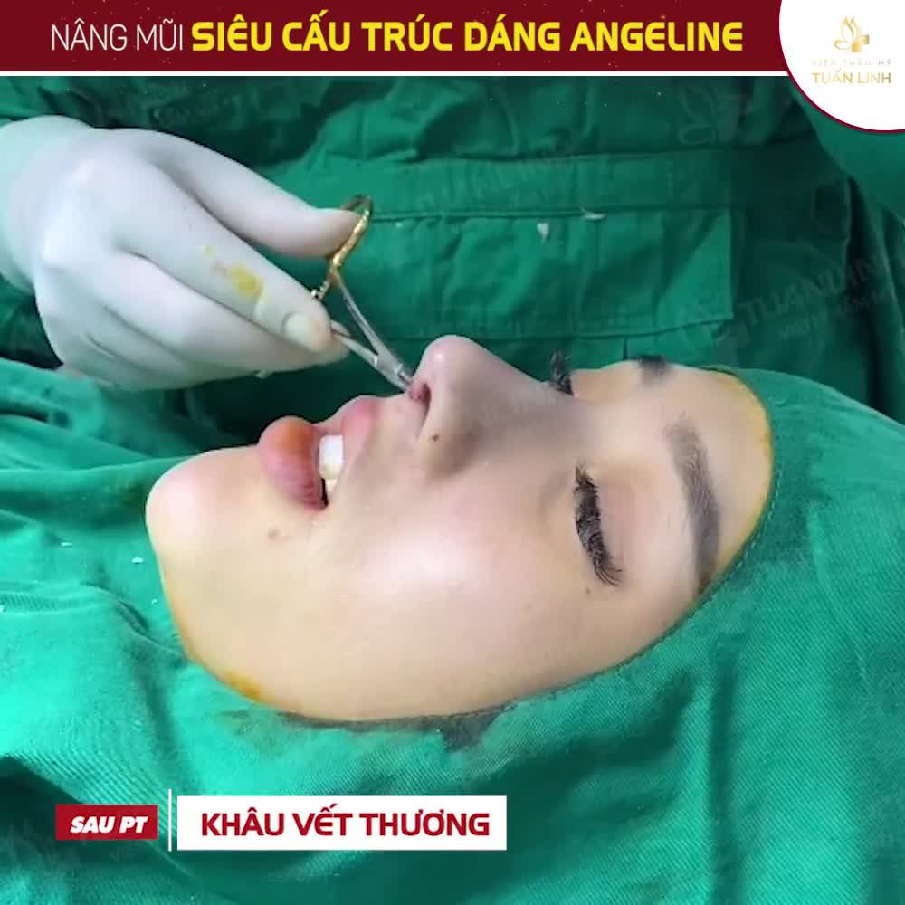 TỪ A-Z QUY TRÌNH NÂNG MŨI TẠI TUẤN LINH