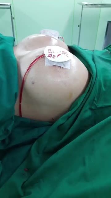 XỬ LÝ NGỰC PHÌ ĐẠI CHẢY XỆ XỬ LÝ NGỰC XỆ KHÔNG SẸO