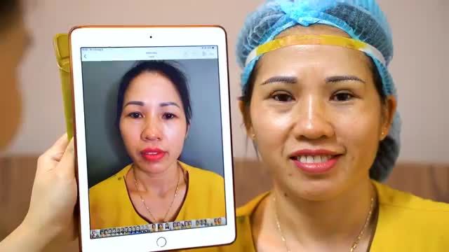 Nâng cung mày giải pháp vàng níu giữ tuổi thanh xuân cho chị em phụ nữ.!