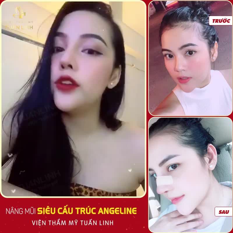 Chỉ 3 từ : SANG, XỊN, MỊN để nói về nhan sắc của cô nàng Sa ra Trần  sau khi sở hữu dáng mũi Angle Line " thần thánh" nhà Tuấn Linh.