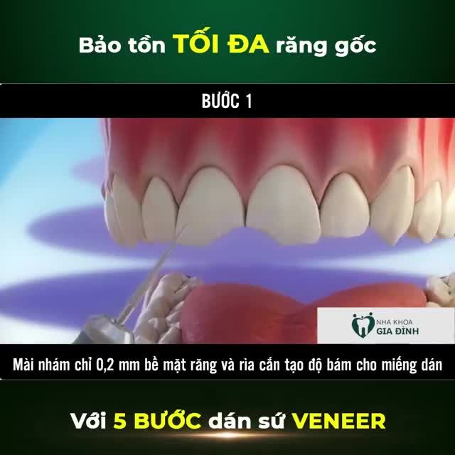 MÔ PHỎNG DÁN SỨ VENEER ĐẠT CHUẨN TẠI NHA KHOA GIA ĐÌNH