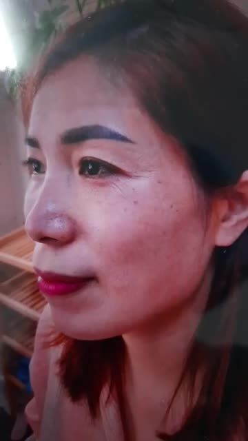 GHÉP MỠ MẶT BABY - MÁ ĐÀO TÀI LỘC