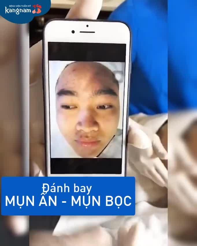 Sau 5 BUỔI  Diệt gọn MỤN ẨN, MỤN BỌC