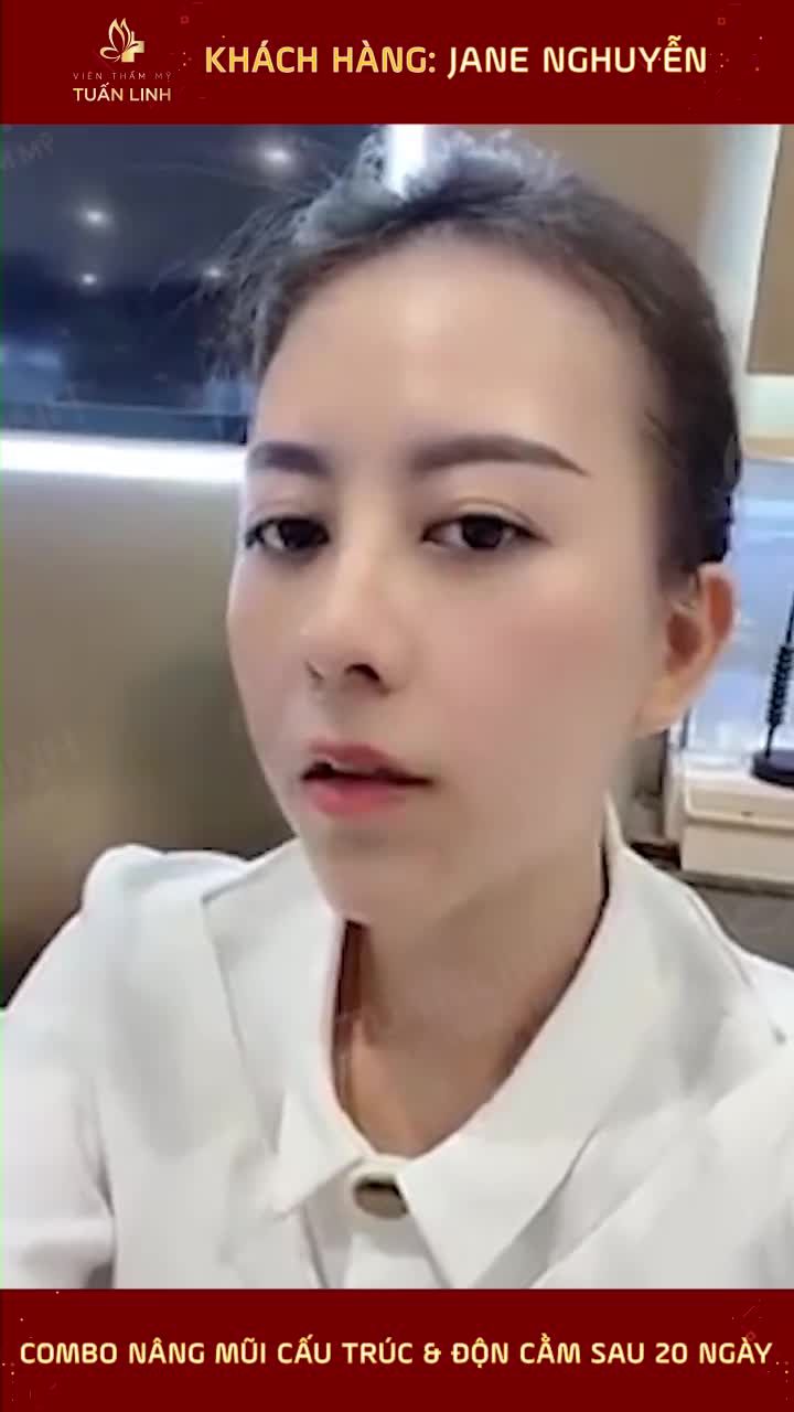 NÂNG MŨI ĐỘN CẰM SAU 20 NGÀY SẼ NHƯ THẾ NÀO