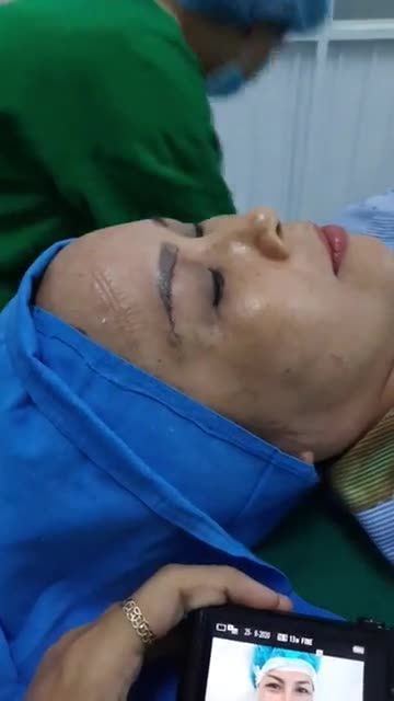 TREO MÀY PHONG THUỶ ĐƯỜNG KHÂU MẢNH KHẢNH - KHÔNG SẸO