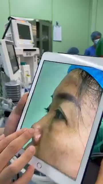NÂNG MŨI CẤU TRÚC SỤN SƯỜN