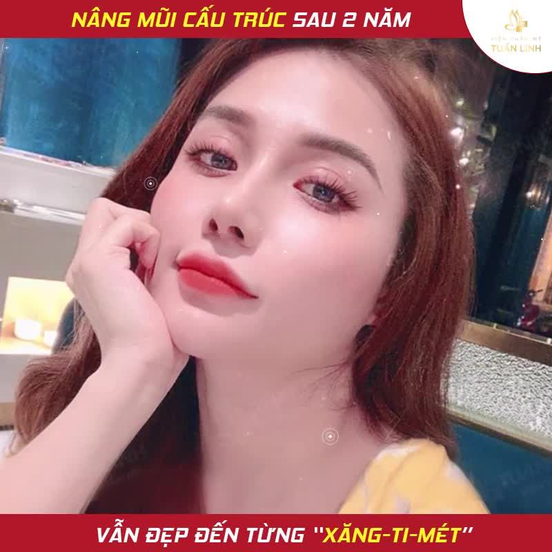 NÂNG MŨI SAU 2 NĂM VẪN ĐẸP ĐẾN TỪNG XĂNG TI MÉT- CHỈ CÓ THỂ LÀ NÂNG TẠI TUẤN LINH.
