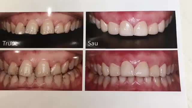CA GẮN SỨ THẨM MỸ, THAY ĐỔI NỤ CƯỜI