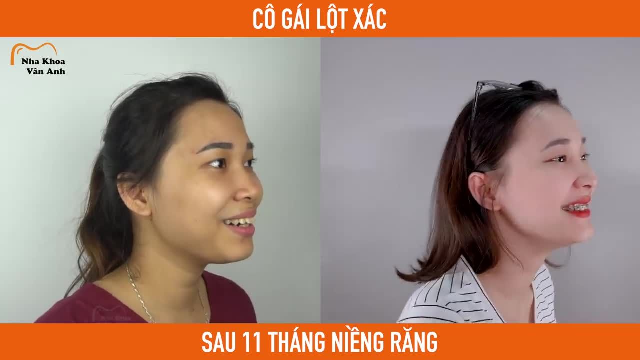 CÔ GÁI LỘT XÁC NGOẠN MỤC SAU 11 THÁNG NIỀNG RĂNG HÔ
