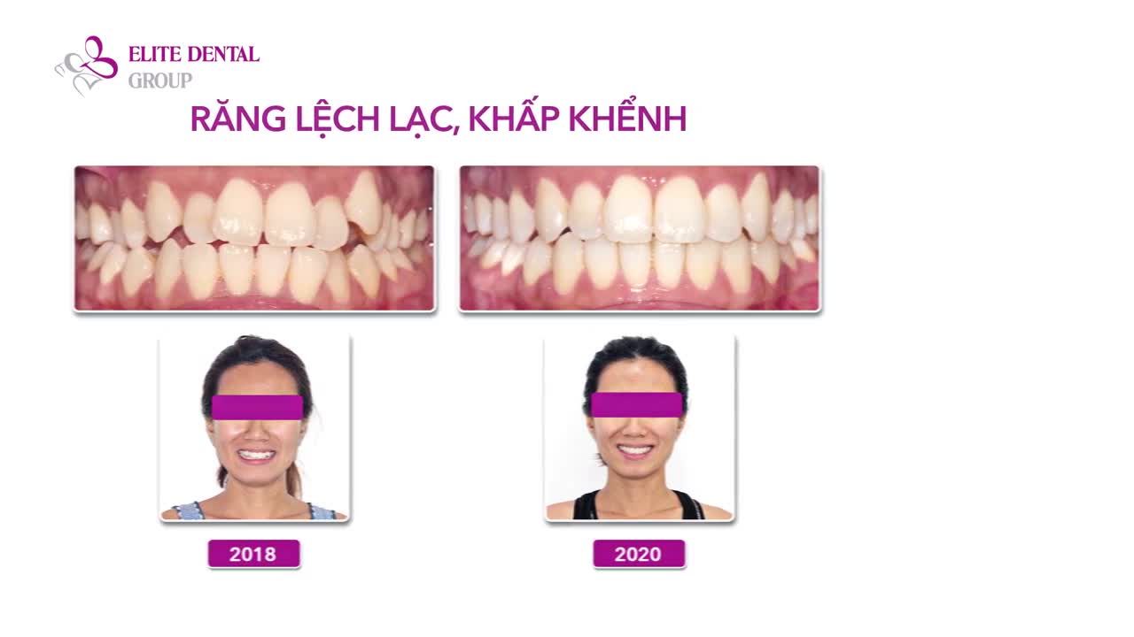 Elite Dental - Tự hào về đích thành công cho hàng trăm ca niềng răng Invisalign
