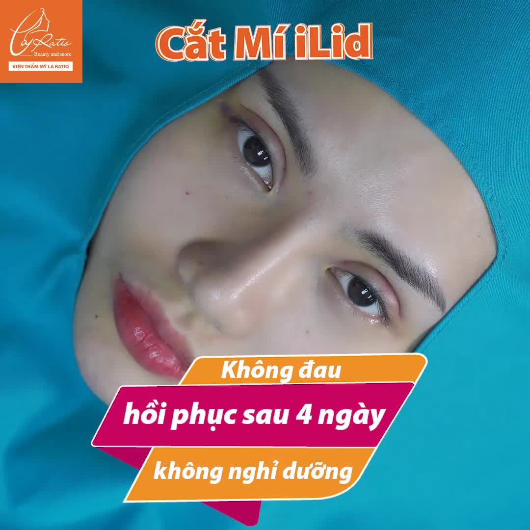 Mắt một mí, sụp mí, mí không đều giờ đây trở thành đôi mắt cuốn hút hơn với phương pháp cắt mi iLid chỉ sau 45 phút thực hiện.
