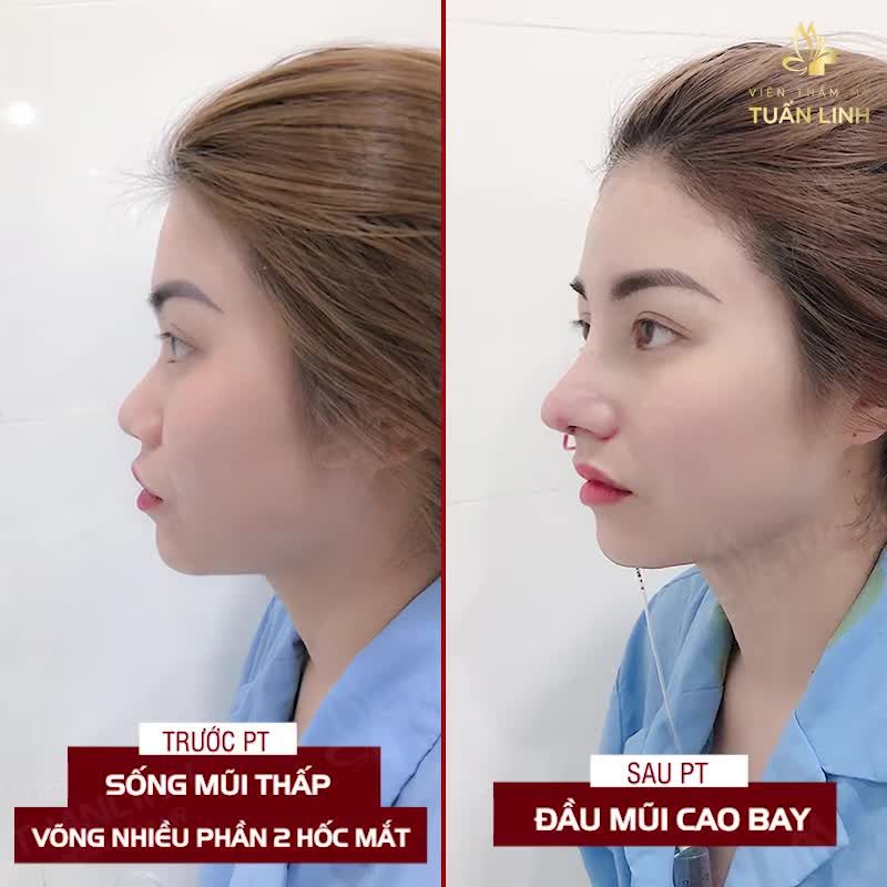 Nâng mũi không những giúp bạn đẹp hơn mà còn tốt cho phong thủy giúp công việc, sự nghiệp được thuận lợi thăng tiến, tình yêu bền vững và thăng hoa.