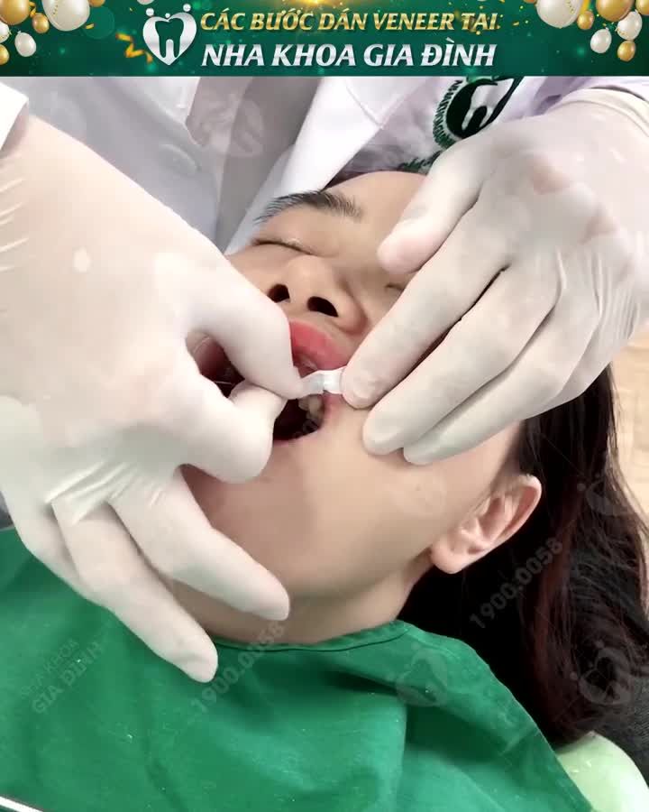 RĂNG XẤU CỠ NÀO – LÀM ĐẸP CỠ ĐÓ VỚI DÁN SỨ VENEER