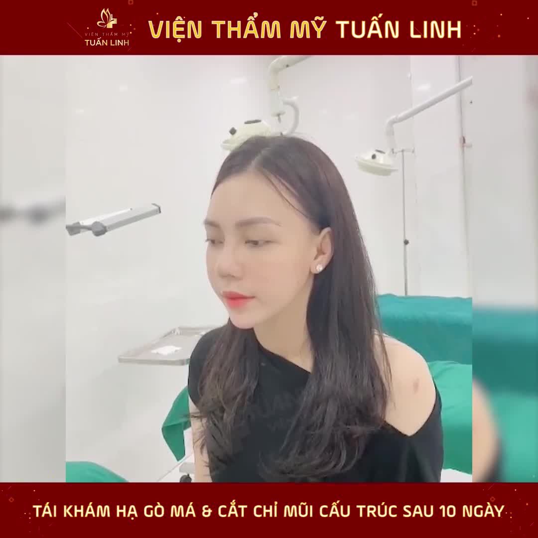Khách hàng TÁI KHÁM SAU 10 NGÀY HẠ GÒ MÁ + NÂNG MŨI CẤU TRÚC tại VTM Tuấn Linh.