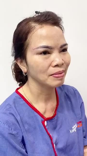 Kết quả sau 30 phút Nâng cung mày